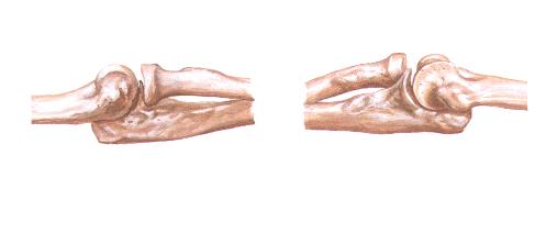 4岁左桡骨小头骨皮质断裂,小孩桡骨小头发育缺失