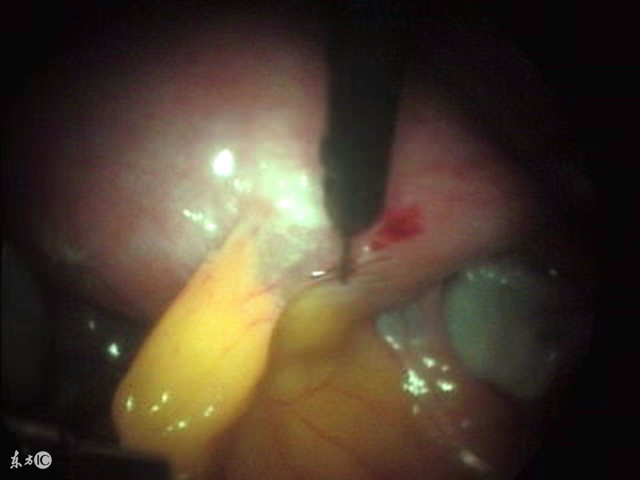 做腹腔镜手术需要多少钱啊,做腹腔镜手术需要插管吗