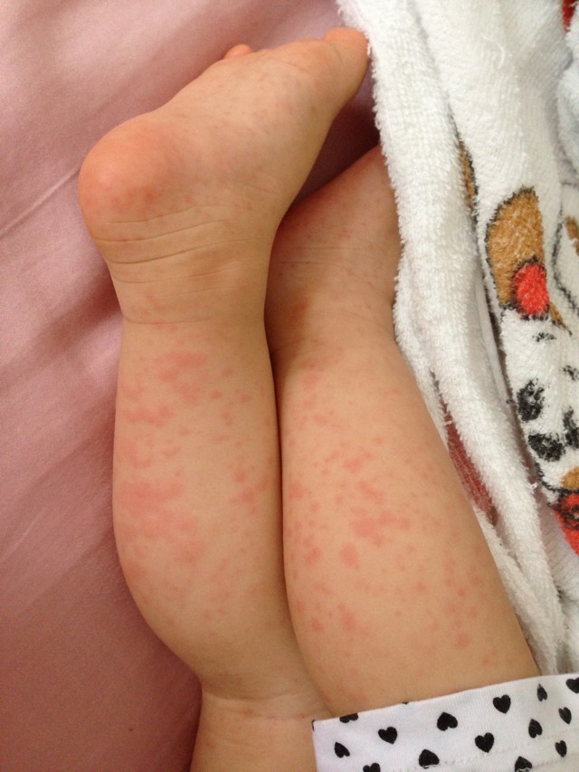 九个月宝宝出了一身疹子,9个月宝宝出些小红疹低烧