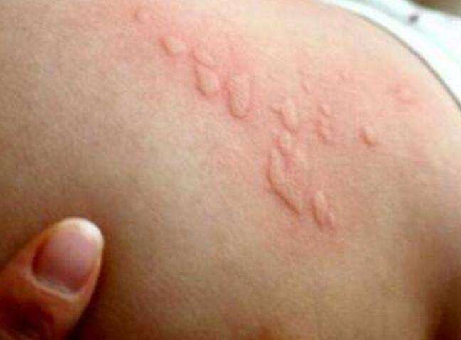 宝宝身上长密密麻麻小疙瘩怎么办,宝宝身上长小疙瘩不红