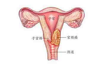 宫颈癌疫苗可以预防什么病,宫颈癌患者可以打宫颈癌疫苗吗