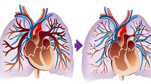 肺动脉高压必死无疑是怎么回事,肺动脉高压心衰能活几年