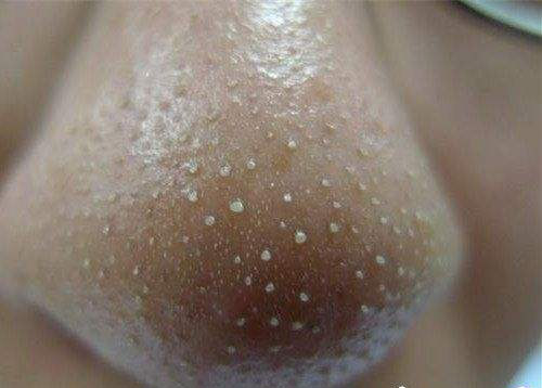 鼻子上挤出来的白色东西怎么去除,鼻子上会挤出白色的东西怎么改善