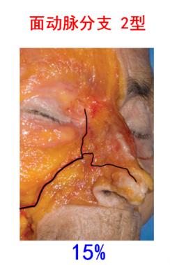 面部注射后血管栓塞图,面部注射栓塞的视频