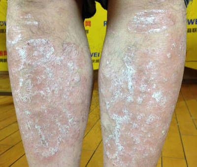 银屑病难治？用对药就简单，试试这种农村的野菜吧！