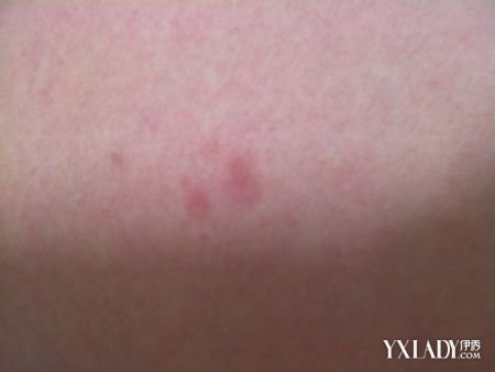 身上起红疙瘩像过敏是怎么回事,身上起疙瘩过敏了怎么办