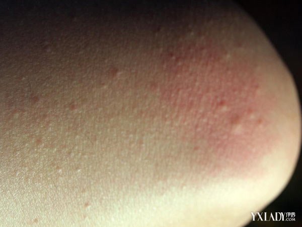 身上起红疙瘩像过敏是怎么回事,身上起疙瘩过敏了怎么办