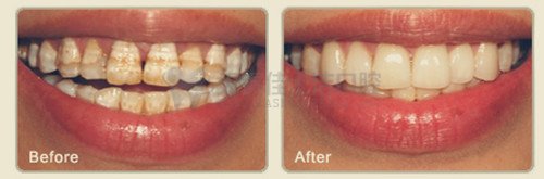 氟斑牙,氟斑牙怎么治疗最有效果