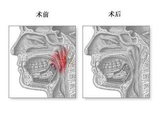 儿童鼻腺样体肥大怎么治疗,小儿鼻腺样体肥大怎么办