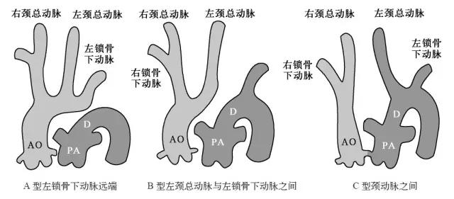 超声主动脉瓣重度狭窄,主动脉弓闭锁