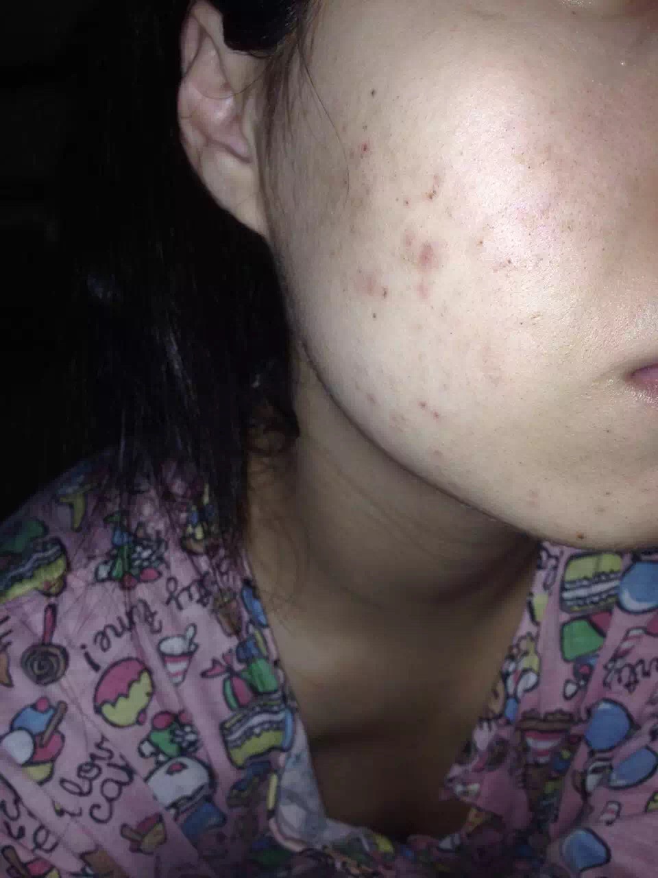 慎入！春季多发激素脸！你还要不要脸？