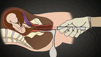 堕胎手术有多可怕,做了堕胎手术