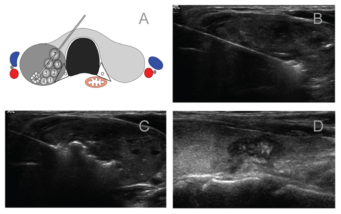甲状腺微创介入治疗技术成熟吗,超声介入治疗桥本氏甲状腺炎
