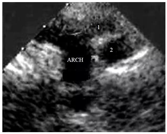 超声主动脉瓣重度狭窄,主动脉弓闭锁