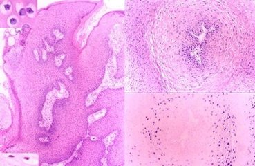 cdc性传播疾病治疗指南,std性传播疾病