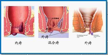 她肛门涨的难受，非常不舒服，以为有啥不好的事情呢