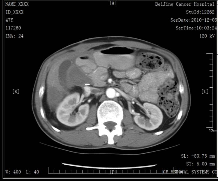 病例转移,胰腺癌晚期肝和腹腔转移