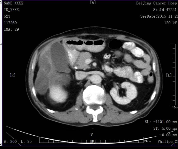 病例转移,胰腺癌晚期肝和腹腔转移