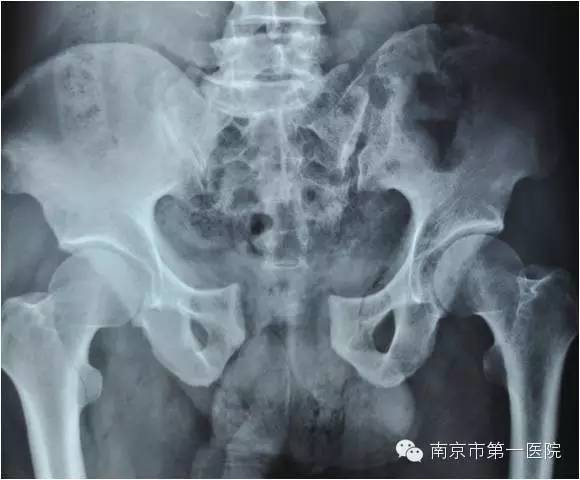 车轮碾压属于什么骨折,被车轮碾压是压缩性骨折吗