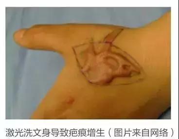 这样的文身，女孩涂后红疹起泡留疤都来了，你还敢玩吗？