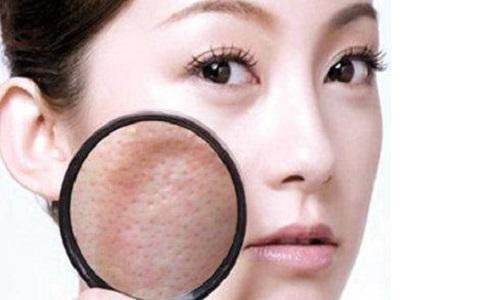 混合性皮肤长痘用什么祛痘,出油毛孔粗大长痘怎么办