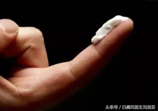 白癜风激素药该如何服用,白癜风患者用药