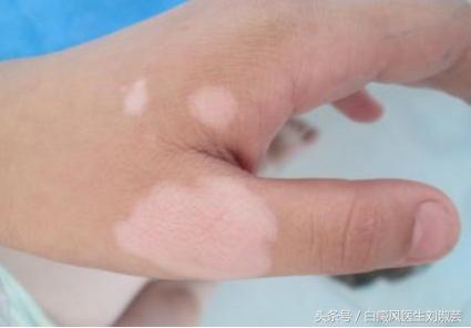 白癜风激素药该如何服用,白癜风患者用药