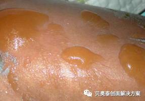 烧伤的诊断标准图表,烧伤病人典型症状