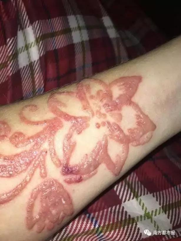 女子洗纹身后破溃化脓了,纹身烫伤起泡会留疤吗