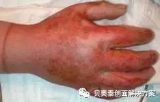 烧伤的诊断标准图表,烧伤病人典型症状