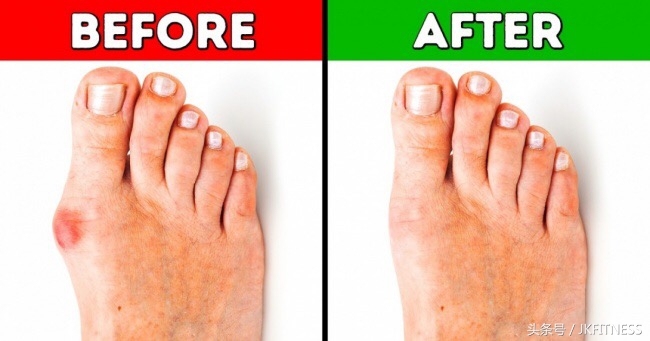 脚拇指外翻微创和复位哪种效果好,五十多岁了脚大拇指外翻能治愈吗