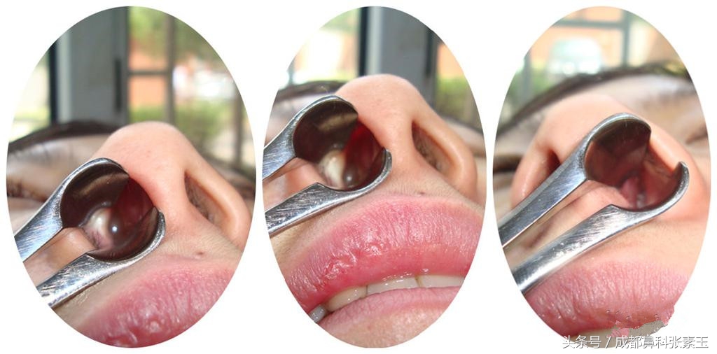 鼻息肉术后还有息肉怎么办,鼻息肉术后怎样恢复