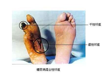 不是危言耸听，手上这个横纹变深有截肢风险，快点自测！