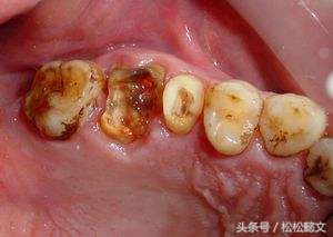 蛀牙为什么要治很多次,牙齿蛀牙高发如何有效预防和治疗