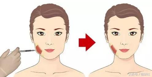 瘦脸针咬肌克星,消除咬肌的瘦脸针