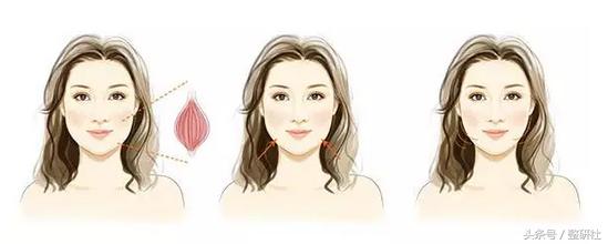 瘦脸针咬肌克星,消除咬肌的瘦脸针