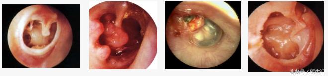 听力低频降落怎么恢复,低频听力降落耳鸣怎么治疗