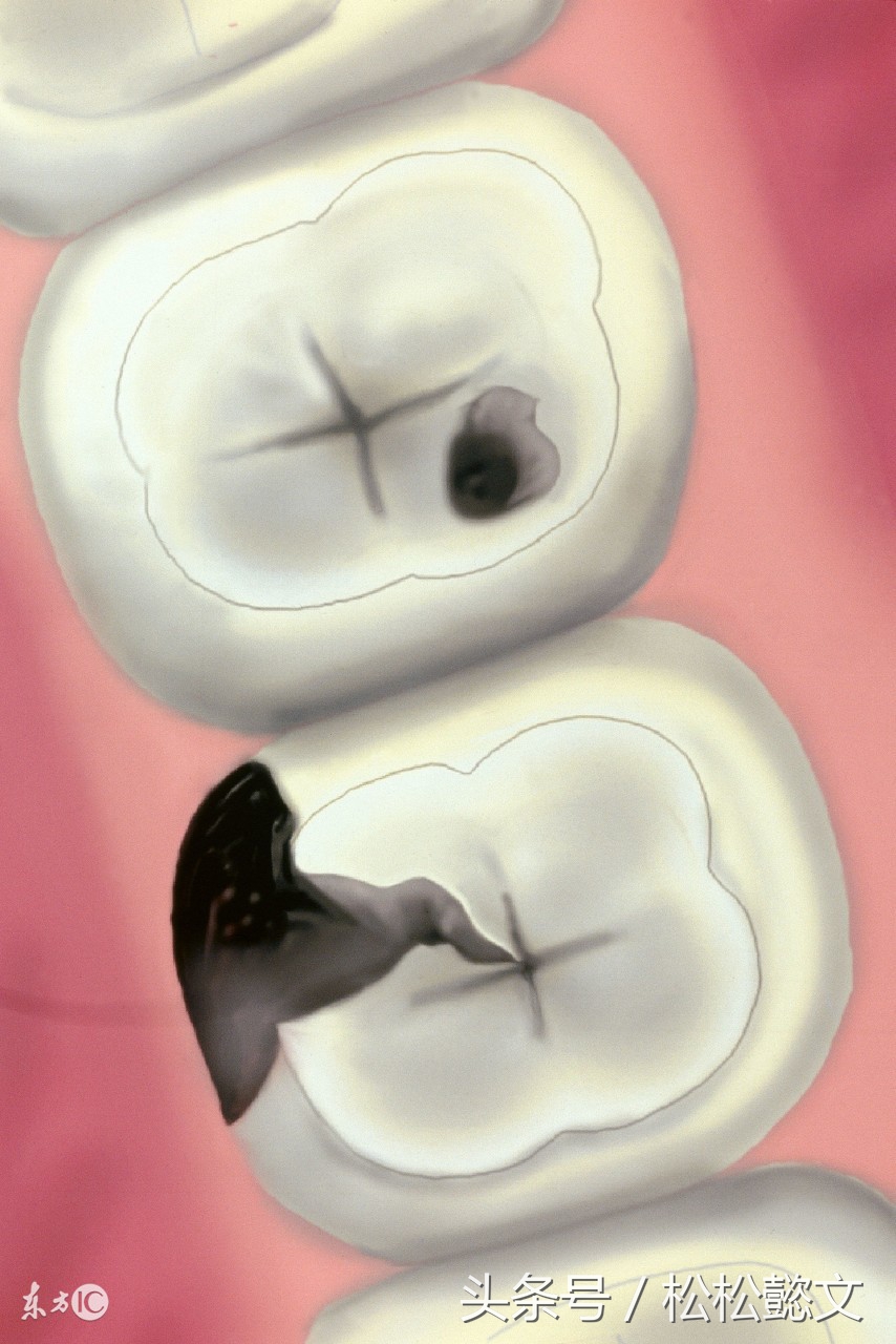 蛀牙为什么要治很多次,牙齿蛀牙高发如何有效预防和治疗