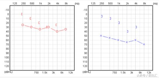 听力低频降落怎么恢复,低频听力降落耳鸣怎么治疗