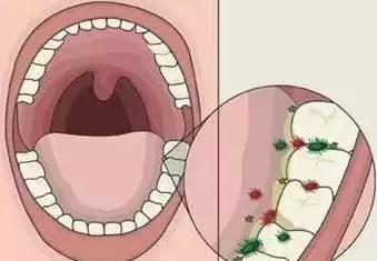 塞牙塞的厉害怎么办,塞牙塞到牙龈里咋回事