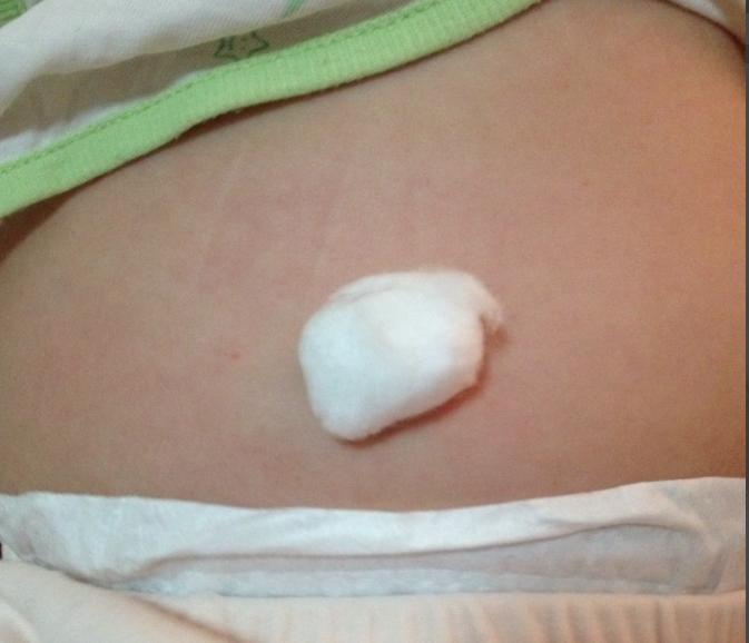 宝宝肚脐胀气肚脐突出来怎么回事,50多天的婴儿肚脐突出是怎么回事