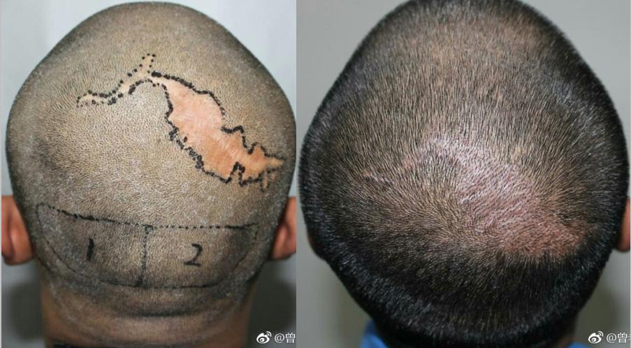 除了植发，就没有方法能拯救你头上的疤？有！
