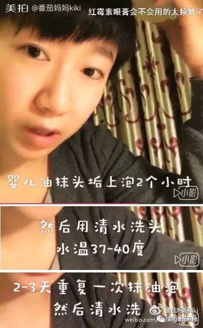 幼儿头垢和湿疹结痂的区别,湿疹洗澡用什么清洗