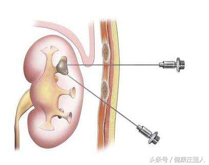 肾穿刺并非金科玉律，它可能会造成严重后果