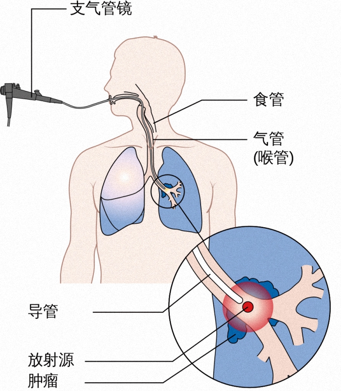 北京胸科三甲医院,三甲医院胸透