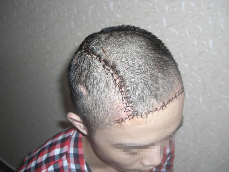 除了植发，就没有方法能拯救你头上的疤？有！