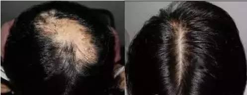 除了植发，就没有方法能拯救你头上的疤？有！