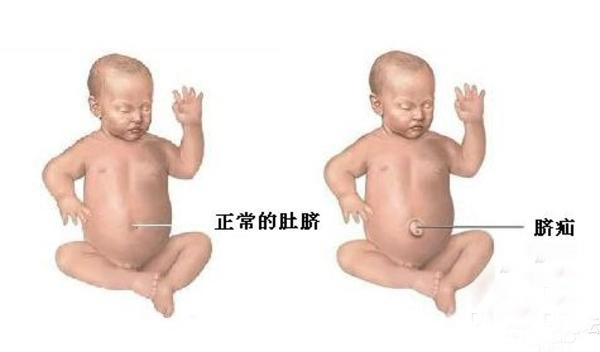 宝宝肚脐胀气肚脐突出来怎么回事,50多天的婴儿肚脐突出是怎么回事