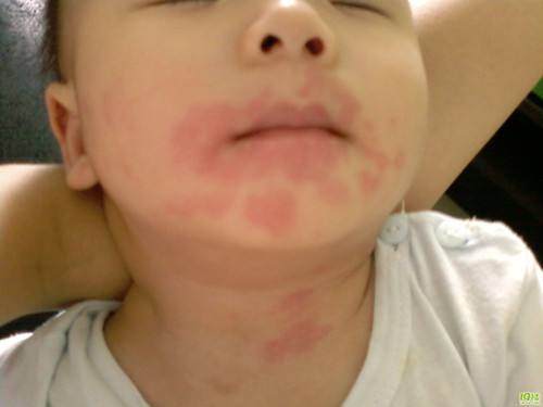 3岁宝宝过敏性荨麻疹吃什么药,3岁宝宝荨麻疹反复发作怎么办