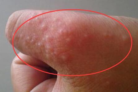 冬天手痒里面有小水泡加脱皮,中医手上起小水泡很痒怎么办